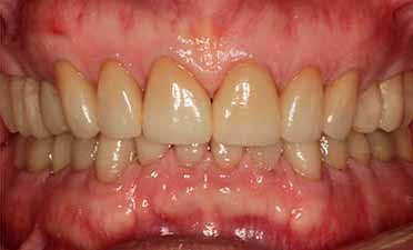 Complete Restorative Teeth Oshawa Durham Region After Image