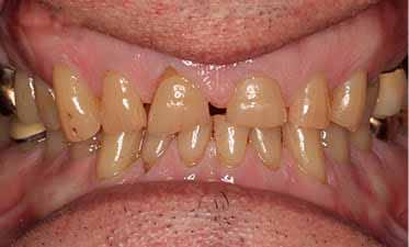 Complete Restorative Teeth Oshawa Durham Region Before Image