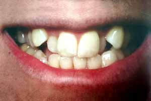 Dental Braces Dentists In Oshawa Durham RegionOntario