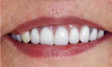 Dental Reconstruction Crowns Oshawa Durham Region After Image