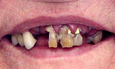 Dental Reconstruction Crowns Oshawa Durham Region Before Image