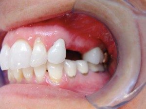 Dentists For Mini Dental Implants Oshawa ON