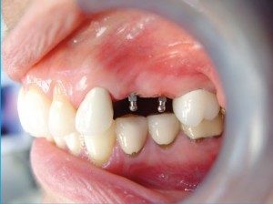 Mini Dental Implants: Step 2