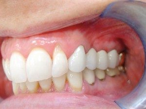 Mini Dental Implants: Step 3